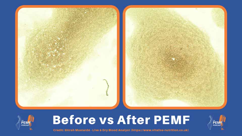 Inflammation in blood shown before and after PEMF therapy