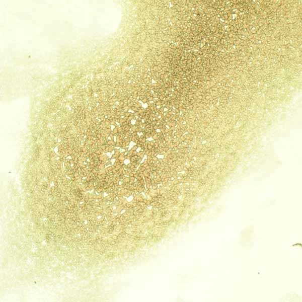 Dry blood sample showing inflammation before a session of PEMF therapy on CELLER8