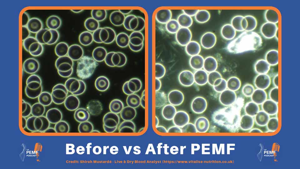 White blood cells shown before and after PEMF therapy